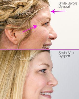 smile wrinkles erased with Botox