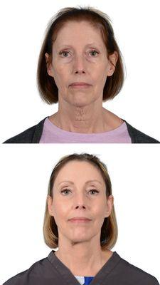 Amazing results after Dr. Mentz performed a Facelift, Necklift, Browlift, Lower Blepharoplasty, and Fat-grafting to the mouth and mid-face.