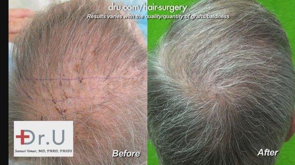 Before and after Dr.UGraft BHT Repairs (Body Hair Transplant Repairs) - The Best in Los Angeles