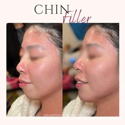 Chin filler