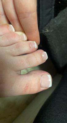 Cut multiple toes on both feet