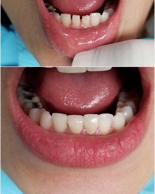 Actual Patient . . . Before & After
                         2 Unit Lower Anterior