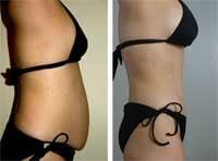 Before and After Abdominoplasty