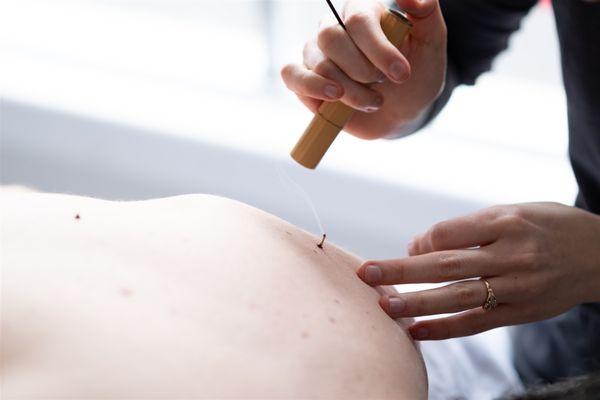 Moxibustion