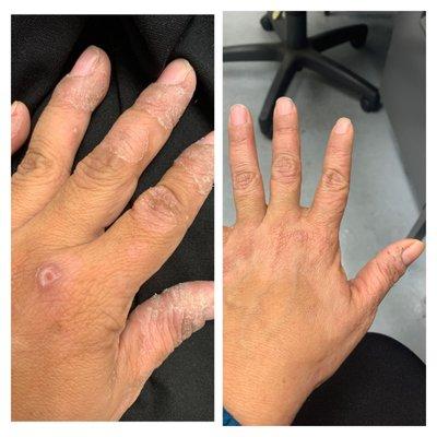 Psoriasis before after