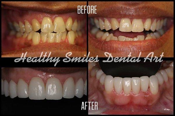 Smile transformation through Veneers done by our very own Dr. Grecy.