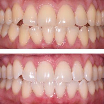 ZOOM in-office whitening, before and after.