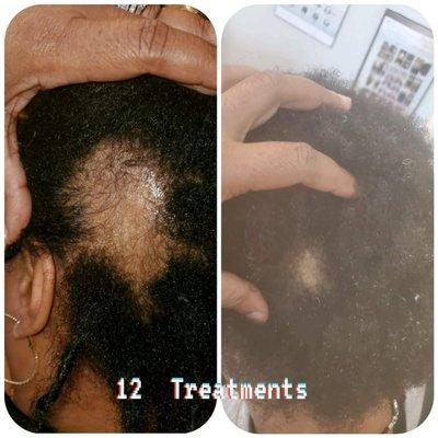 Great results with treatment of Alopecia Areata.