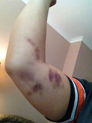 Bruises from a routine lab draw