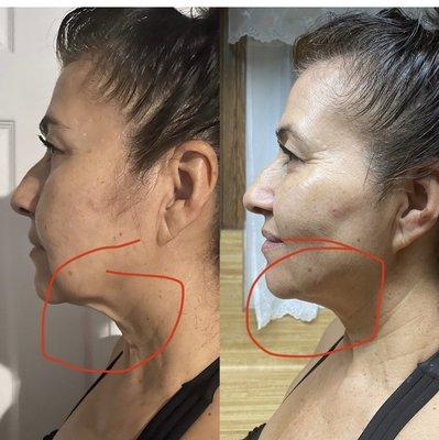 Loose sagging skin in the neck removed in one session! RF facials will tighten skin and regenerate new collagen!