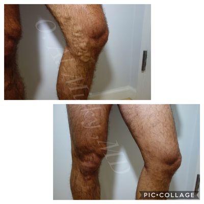 25 years old male treated for Varicose veins . Vein ablation and Sclerotherapy injections performed .