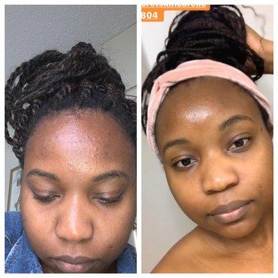 Custom Acne Treatment 1 month apart