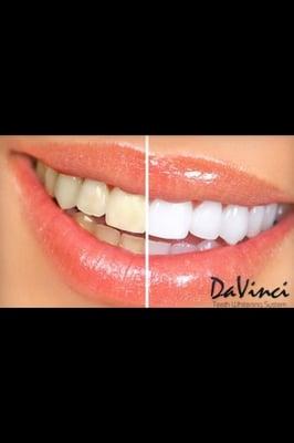 Davinci LED laser teeth whitening studio at Melange.