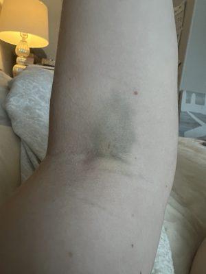 Four days after blood draw