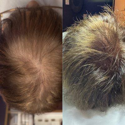 MD Stem Cell Hair Restoration