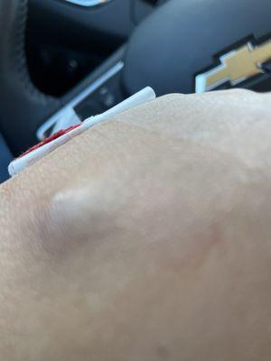 Swollen site of blood draw