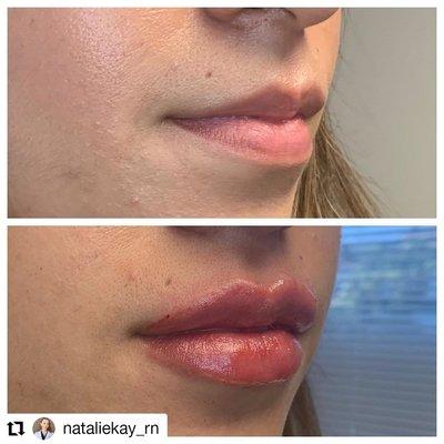 Lip injection performed by our nurse injector, Natalie.  @nataliekay_rn