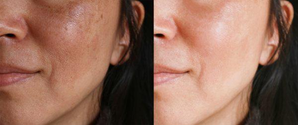 Microneedling RF Dark Spots Removal Before & After