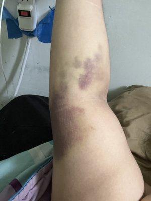 Bruises