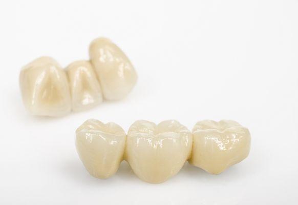 Layered Zirconia Bridge