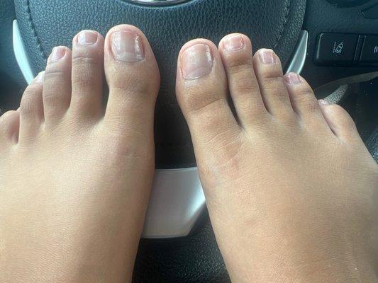 Toes uneven