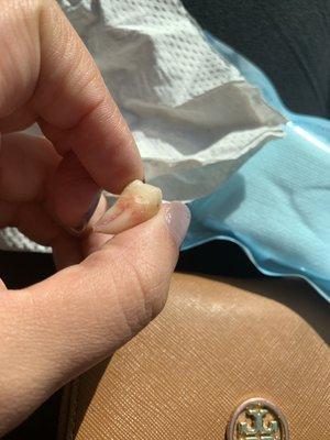 Wisdom tooth, huge and difficult to pull out