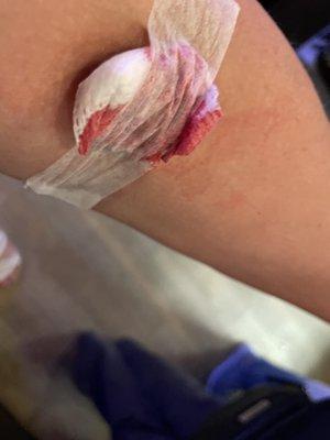 My arm after Melissa free blood