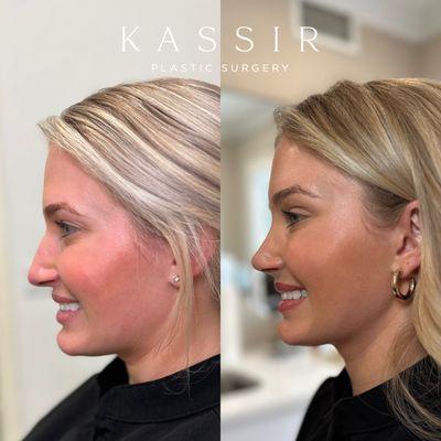 3 weeks after Endoscopic Brow Lift and Designer Rhinoplasty®