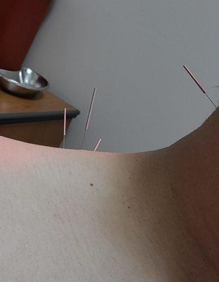 Neck/Shoulder pain treatment-Acupuncture