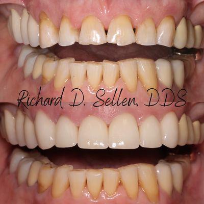 Wow what a difference! This patient was concerned about their tooth wear. Now they can smile with confidence!