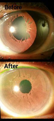 Cataract removal and scar tissue  cleanup