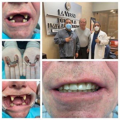 Implant Supported Partial Dentures