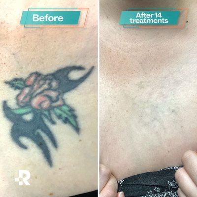 Removery Tattoo Removal & Fading