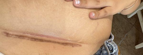 Tech cut me above my c-section scar