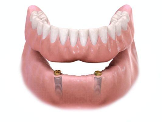 Overdentures are replacement teeth retained by dental implants. The improved stability allows you to chew food more thoroughly no adhesives.