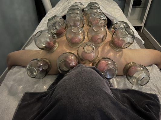 Cupping