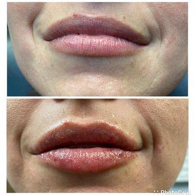 1ml of Hyaluron Pen / Lip Plumping added volume and slight pout