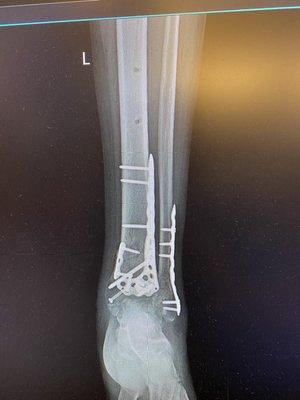 Pilon fracture. Patient jumped off a boat with injury to the ankle