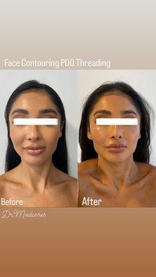 PDO Threading, Face Contouring without Fillers