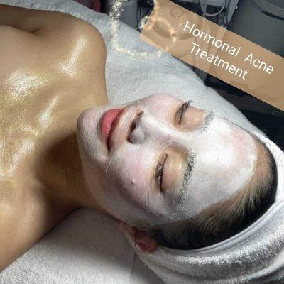 Adult Acne Facial