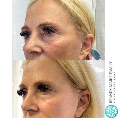 Before and After One Opus Treatment