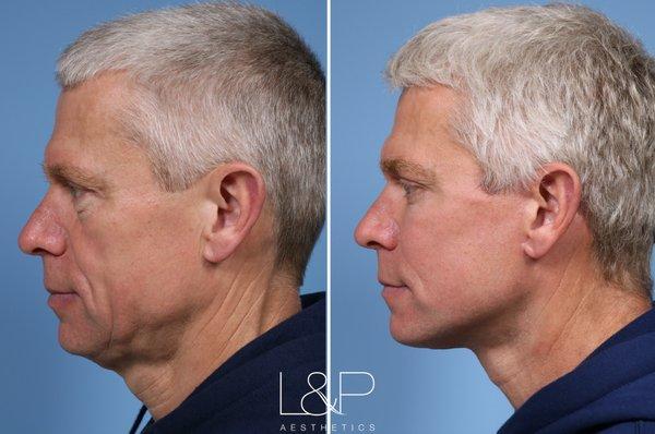 Male Facelift & Neck Lift