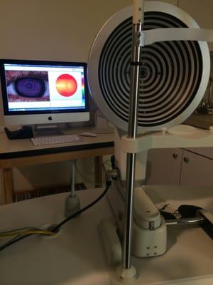 Corneal Topography to manage keratoconus and irregular astigmatism