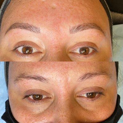 Brow rehab