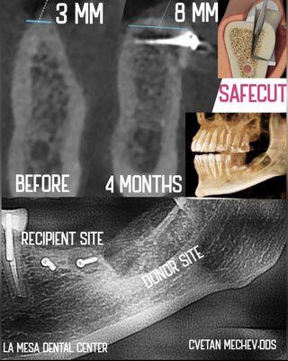 5 mm Horisontal Bone Grafting for Dental Implants