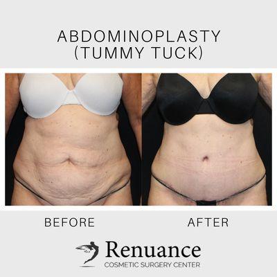 Tummy Tuck at Renuance Cosmetic Surgery Center & Medical Spa in Murrieta, CA