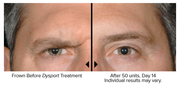 Men's Dysport Brow Treament results