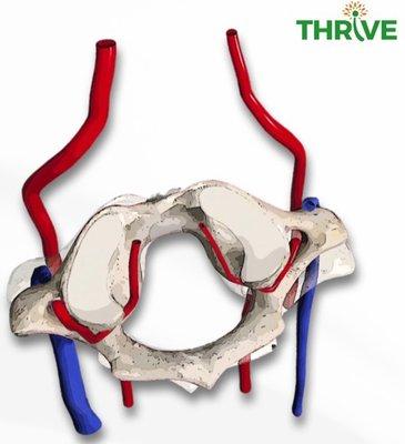 Vertebral artery and internal jugular vein are being compressed due to a misalignment of C1 (aka: atlas bone).