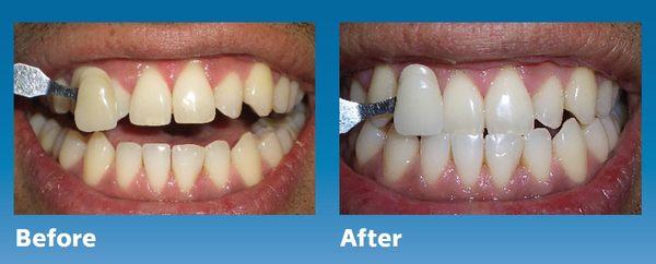 Zoom Teeth Whitening in Windsor by Donna Tovani Windsor California, Whiter Teeth with Zoom Teeth Whitening.