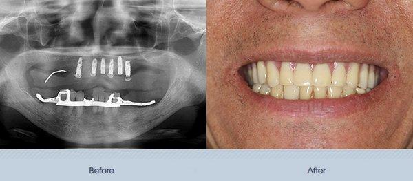 Full mouth implant rehabilitation